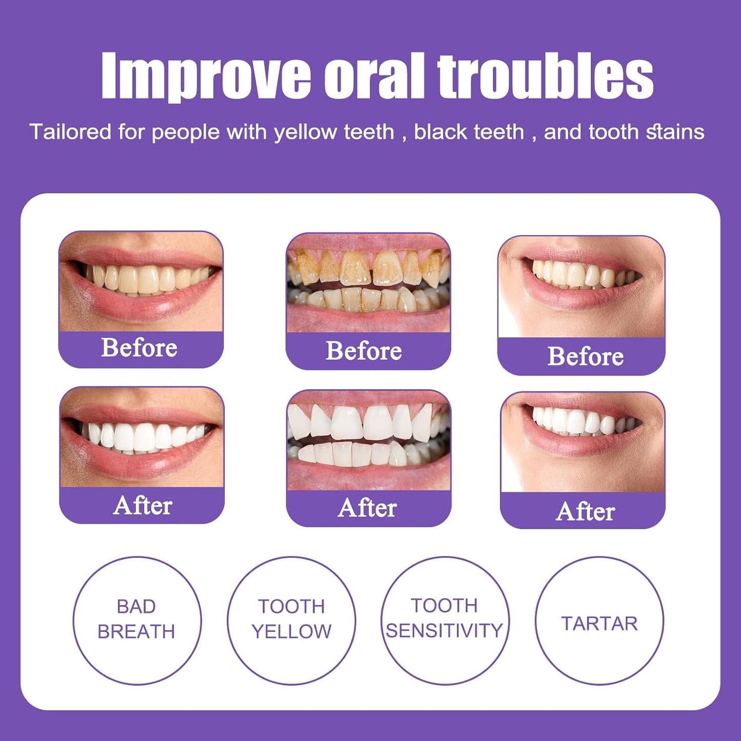 1+1 FREE|HeroSmilekit – Teeth Whitening Kit